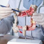 Un nuevo tratamiento para el cáncer colorrectal
