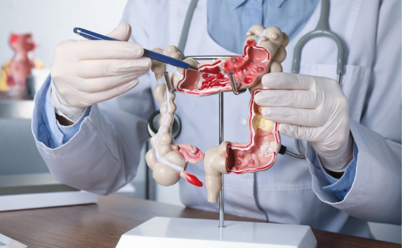 Lee más sobre el artículo Un nuevo tratamiento para el cáncer colorrectal