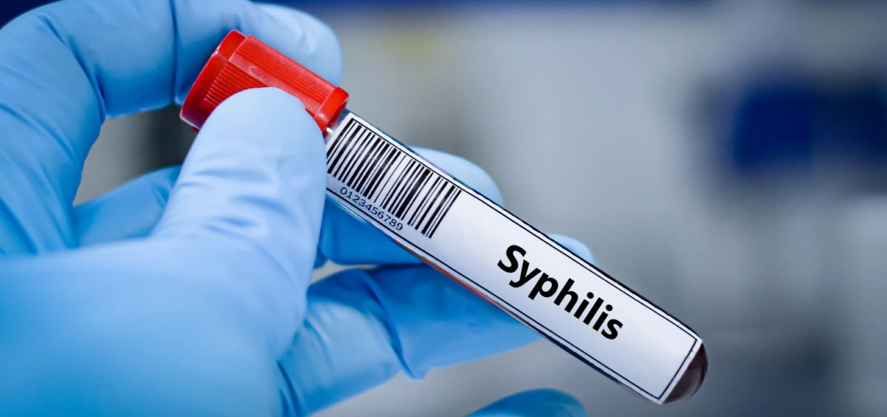 Lee más sobre el artículo Los casos de sífilis crecieron hasta 71% en 2025 y alcanzaron un récord histórico en Argentina