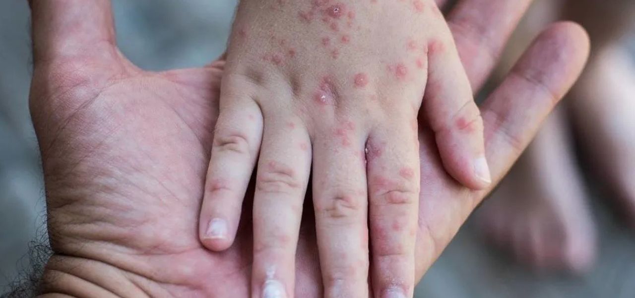 Lee más sobre el artículo Alerta tras el primer caso de sarampión en Argentina en 2026